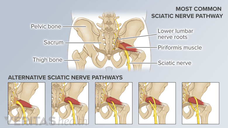 sciatica vertaling
