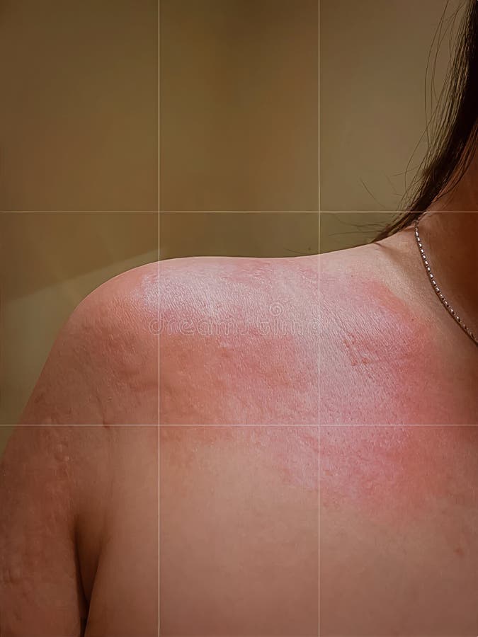 hives vertaling